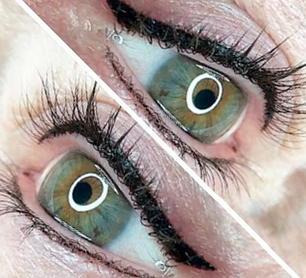 Augen Vergleich nach einer PhiContour Behandlung