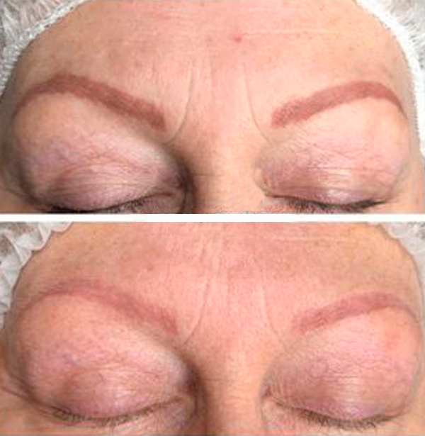 Augenbrauen Vergleich nach einer PhiRemoval Behandlung